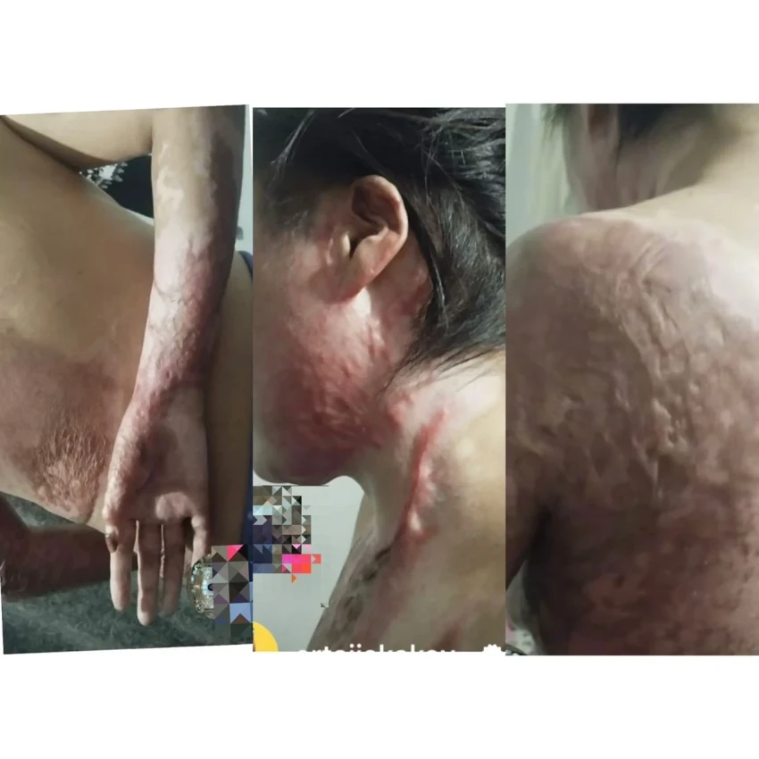 Муж облил жену бензином и поджег — историю пострадавшей обнародовала акыйкатчи